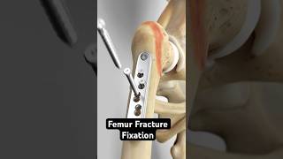 Femur Fracture Fixation Dynamic Hip Screw Method [upl. by Deloris]