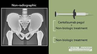 A OneYear PlaceboControlled Study in NonRadiographic Axial Spondyloarthritis [upl. by Eihcir]