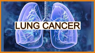 Lung CancerTumors [upl. by Ahsinaj320]