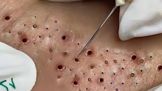 Big Cystic Acne Blackheads Extraction Blackheads amp Milia Whiteheads Removal Pimple Popping  2732 [upl. by Myna]