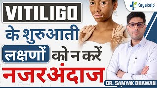 सफ़ेद दाग का फैलना शुरुवात में ही कैसे रोका जा सकता है Vitiligo Early Signs  Kayakalp [upl. by Tabib]