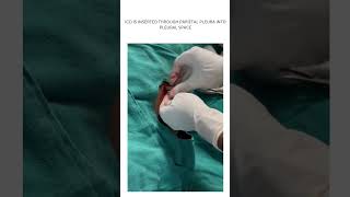 ICD INTERCOSTAL DRAINAGE TUBE INSERTION HOW TO INSERTPUT ICD [upl. by Yrrat501]