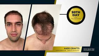 Hair Transplant Turkey Before amp After  8 Months Results [upl. by Marigolda144]