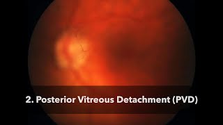 2 Posterior Vitreous Detachment PVD [upl. by Tierney578]