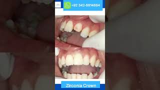 Zirconia Crown before and after cosmeticdentistry [upl. by Nuyh]