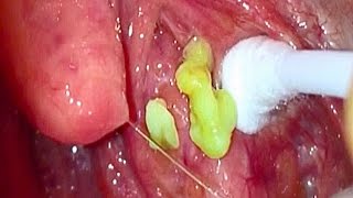 Extreme Tonsil Stones amp Removal Tool [upl. by Alrzc39]