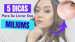 5 DICAS para ACABAR com os MILIUMS no rosto bolinhasnorosto milium bolinhabrancaderostoestetica [upl. by Nester]