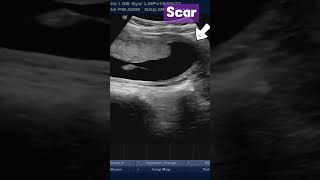 Normal Placenta  in Patient with Previous CSection pregnancy placenta ultrasound baby [upl. by Erin]