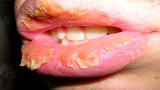 How To Get Rid Of Chapped Lips Permanently  Home Remedies For Chapped Lips [upl. by Amari154]