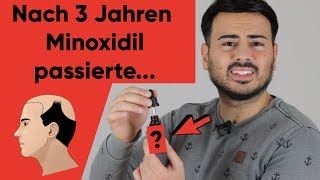 Haarausfall stoppen mit Minoxidil  Meine 3 Jahre Minoxidil Erfahrung [upl. by Prady926]