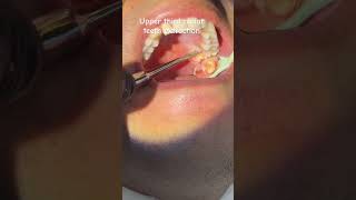 Upper third molar teeth extraction [upl. by Elatia]