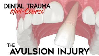 Dental Trauma MiniCourse  Part 12  Dental Trauma Guide  The Avulsion Dental Injury [upl. by Atnovart]