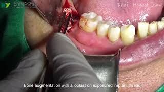 Surgical Regenerative Treatment of PeriImplantitis with TiBrush [upl. by Armillia457]