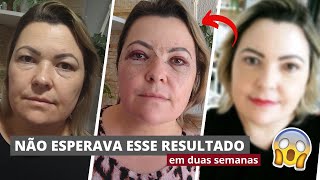 Minha primeira cirurgia plástica  Blefaroplastia [upl. by Oijile]