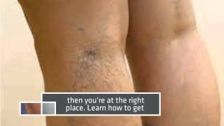 How to Heal Varicose Veins Naturally [upl. by Enerehs753]