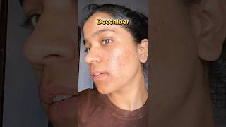 Tretinoin cream before and after  January to December Transformation  tretinoin acne face  🤫 [upl. by Olemrac324]