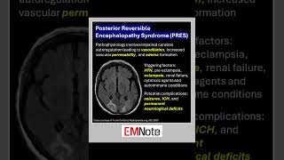 Posterior Reversible Encephalopathy Syndrome PRES doctor medical nursing [upl. by Yelbmik]