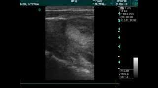 voluminous thyroid nodule ultrasound doppler [upl. by Lonny]