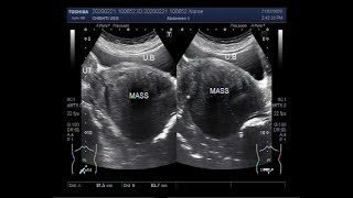 Ultrasound Video showing a large cervical mass [upl. by Jae]