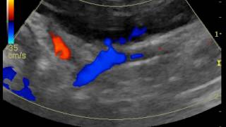 portosystemic shunt through R gastric vein in a dog [upl. by Yesor744]