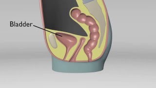 Cystocele No Uterus [upl. by Godart]