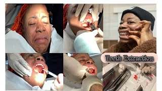 4 Teeth 🦷 Extracted For Braces  premolar Extractions Pt1 [upl. by Myna]