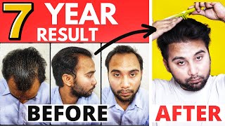 My 7 Years Hair Transplant Result Tips To Maintain Your Hair Transplant Result For Lifetime [upl. by Dumas]