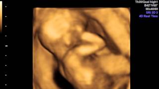 4D Ultrasound  17 Weeks 2 Days [upl. by Nohj]