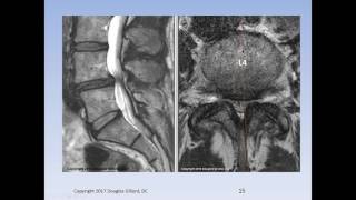 Lumbar Spinal Stenosis Cauda Equina Syndrome Sciatica amp Disc Herniation An Advanced Lecture [upl. by Virendra]