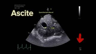 Persistent Dactus Arteriosus associated with congenital aortic stenosis in a dog [upl. by Kristi]