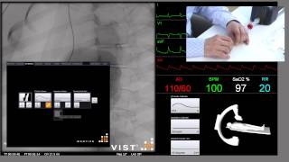 Primary PCI AMI 1 Alternative 2  Mentice VISTC [upl. by Anec]