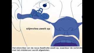 Oorontsteking  Oorzaak en behandeling oorpijn [upl. by Nawd]