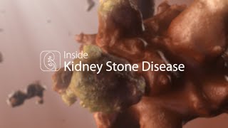 Medical Animation Kidney Stone Disease [upl. by Daria]