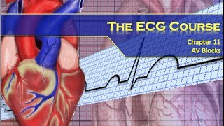 The ECG Course  AV Blocks [upl. by Lozar]