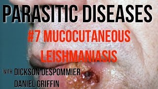 Parasitic Diseases Lectures 7 Mucocutaneous Leishmaniasis [upl. by Gnuoy552]