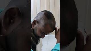 Head wash kaise Kiya jata haihairtransplant hairgrowth hairtransplantation trending ytshorts [upl. by Jael]