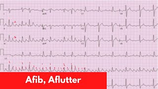 AFib Aflutter MAT  For DO MD NP PA Part 5 [upl. by Dion]