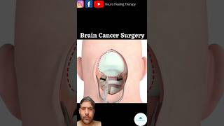 Brain Cancer Surgery 💉😱❤️ doctor anatomy mbbs trendingshorts shortsfeed [upl. by Forrer821]