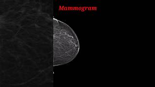 Mammogram trending shorts radiology RadiologyJunction1 [upl. by Mobley]