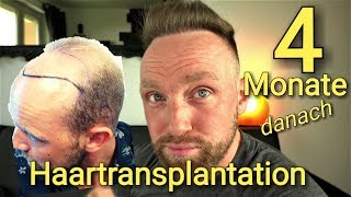 Haartransplantation Barthaare auf Kopf transplantiert 😱4 Monate danach [upl. by Annaj]