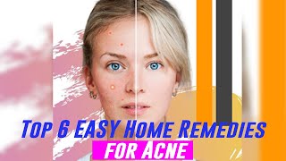 Top 6 EASY Home Remedies for Acne [upl. by Alset970]