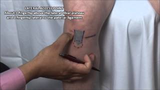 Knee Injection  Anterior Approach [upl. by Munn]