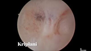 Hysteroscopic adhesiolysis  Dr Alka Kriplani [upl. by Aicitan148]