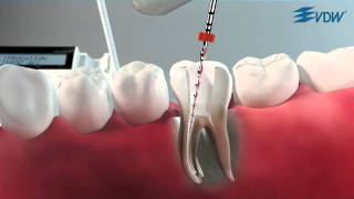 VDW Dental · How To RECIPROC  Reverse Comfort Function [upl. by Enid957]