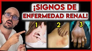 5 SIGNOS en tu PIEL que indican ENFERMEDAD RENAL  ¡AVISAN de MALA FUNCIÓN RENAL [upl. by Zoeller]