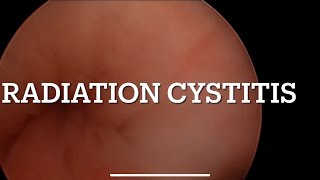 Cystoscopy findings in a case of Radiation cystitis Bodylinehospitals [upl. by Annauqaj]