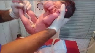 Cutest Newborn Down Syndrome baby after birth is so cute and super Flexible hospital cutevideo🥰🥰💞 [upl. by Kassel855]