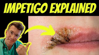 Doctor explains impetigo  causes types and treatment  REAL PHOTOS  Doctor ODonovan [upl. by Rother]