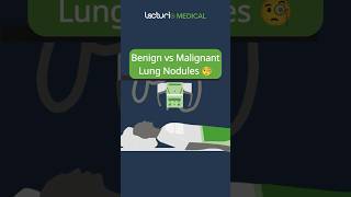 Benign vs Malignant Lung Nodules 🧐 USMLE MedicalEducation Radiology [upl. by Haas]