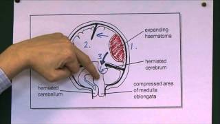 Head Injuries 9 Tentorial herniation [upl. by Krissy]